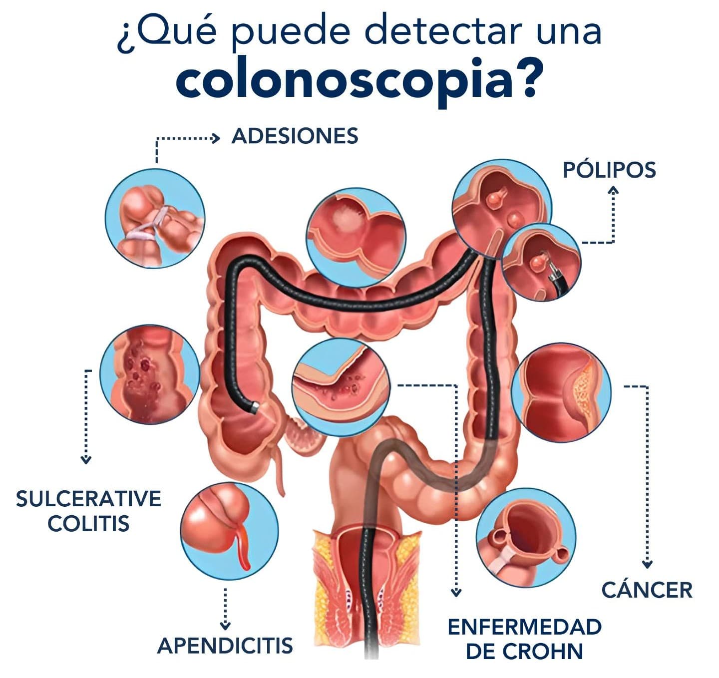 Qué detecta una colonoscopia