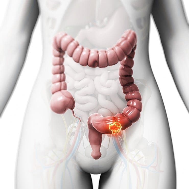 Cáncer de Colon