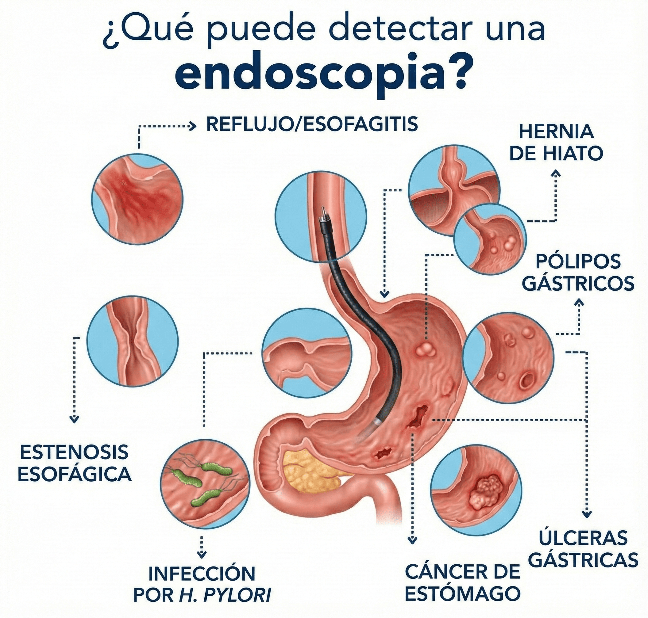 Qué detecta una endoscopia